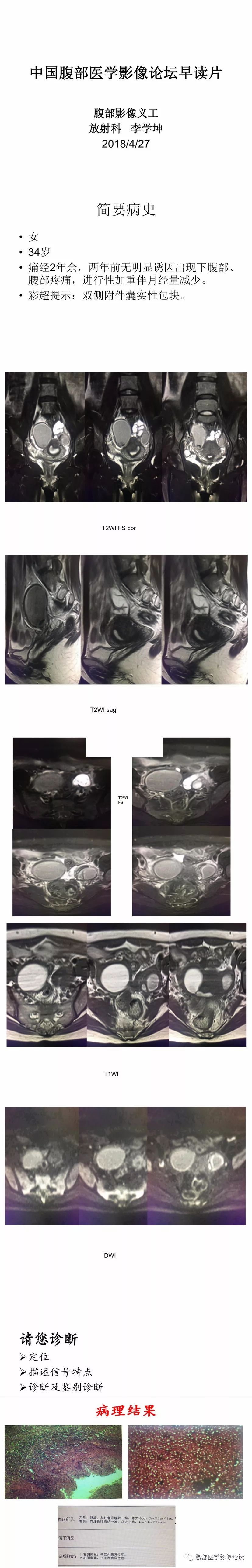 【病例】双侧卵巢子宫内膜异位症1例MR