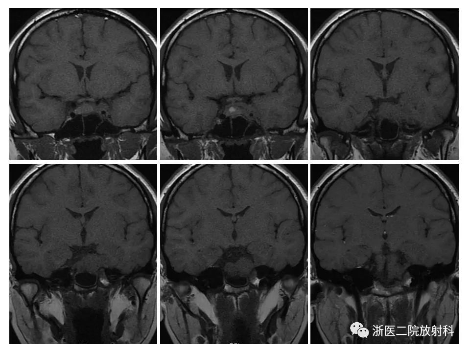 【病例】痛性眼肌麻痹1例MR