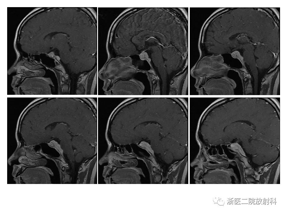 【病例】痛性眼肌麻痹1例MR