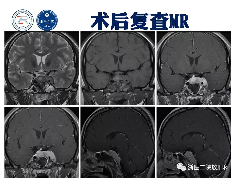 【病例】痛性眼肌麻痹1例MR