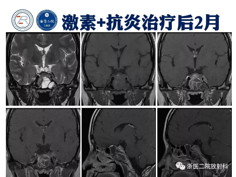 【病例】痛性眼肌麻痹1例MR