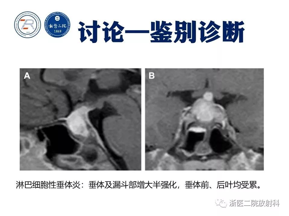 【病例】痛性眼肌麻痹1例MR