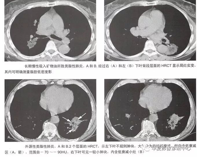 外源性类脂性肺炎