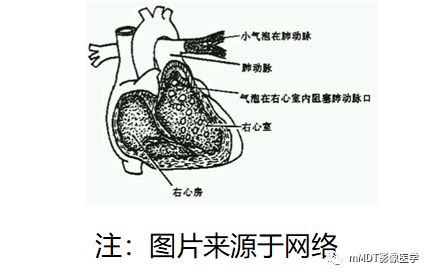 冠状动脉CTA检查中医源性气体相关探讨 冠状动脉CTA检查中医源性气体相关探讨