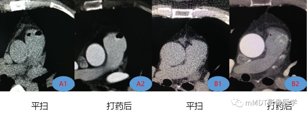 冠状动脉CTA检查中医源性气体相关探讨 冠状动脉CTA检查中医源性气体相关探讨