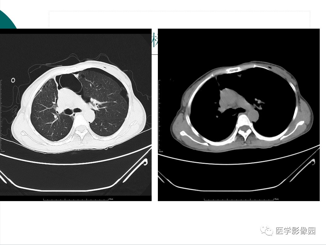 【病例】BHD综合征1例肺部CT