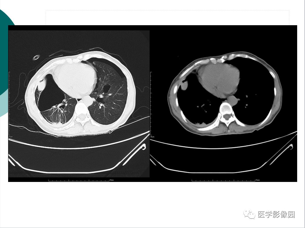 【病例】BHD综合征1例肺部CT