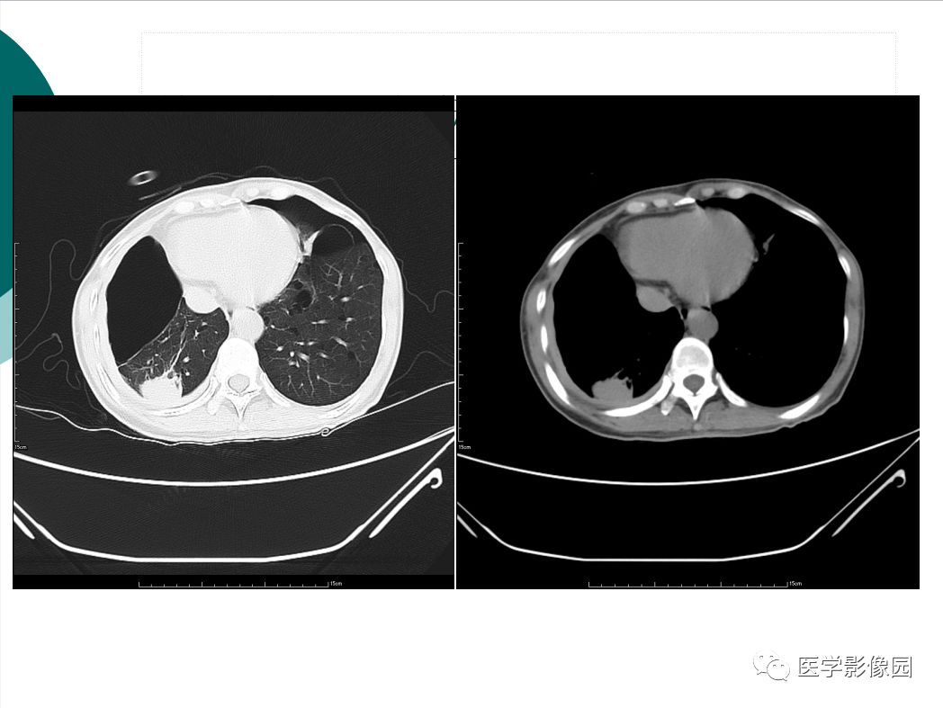 【病例】BHD综合征1例肺部CT
