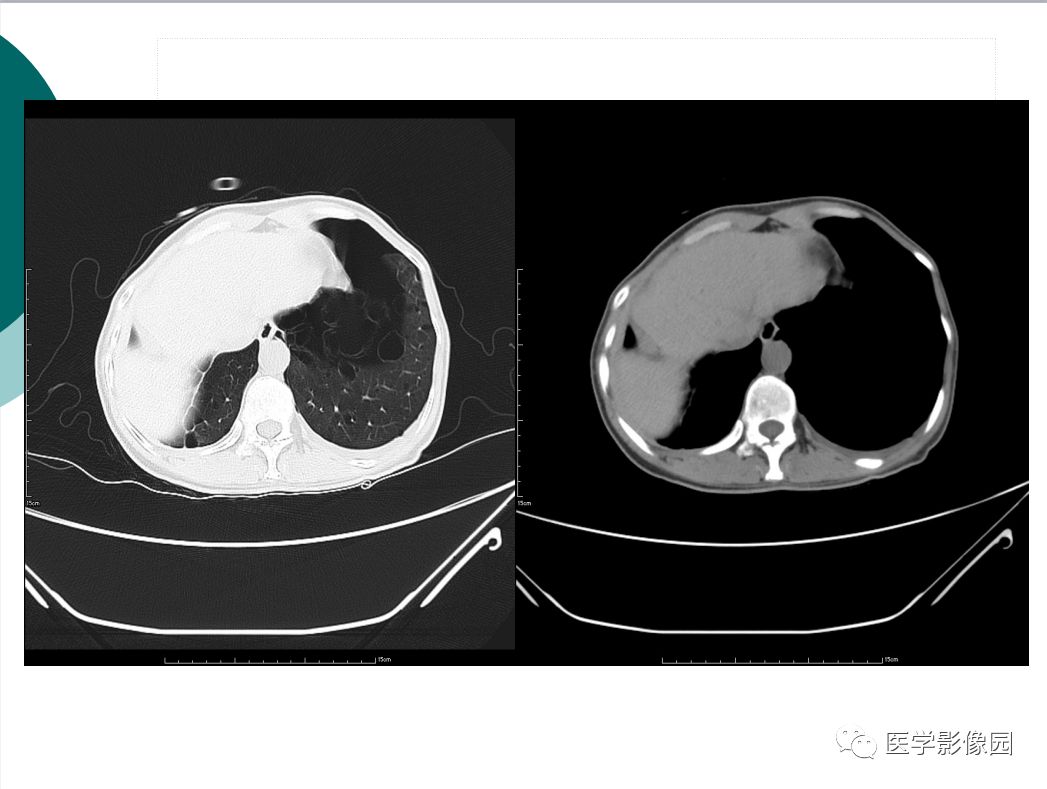 【病例】BHD综合征1例肺部CT
