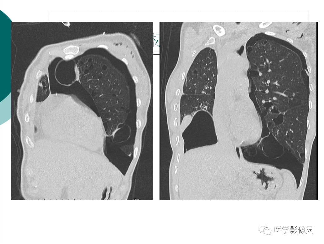 【病例】BHD综合征1例肺部CT