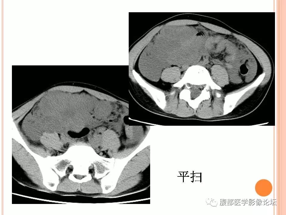 【病例】卵巢甲状腺肿1例CT
