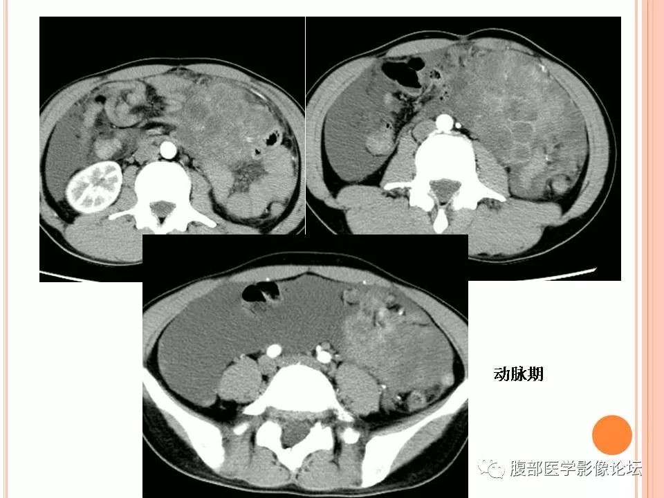 【病例】卵巢甲状腺肿1例CT