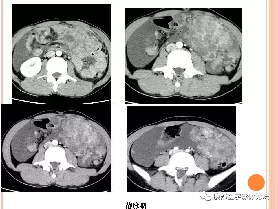 【病例】卵巢甲状腺肿1例CT