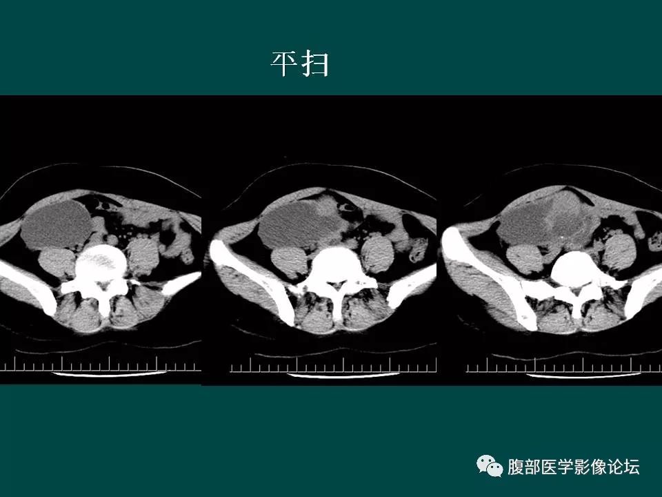 【病例】卵巢甲状腺肿1例CT