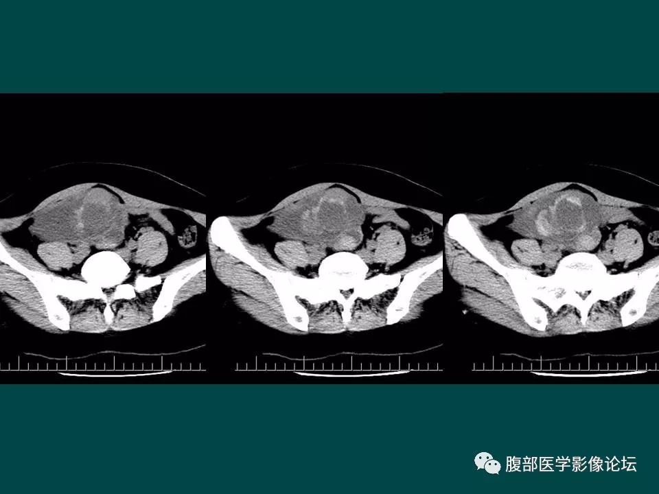 【病例】卵巢甲状腺肿1例CT
