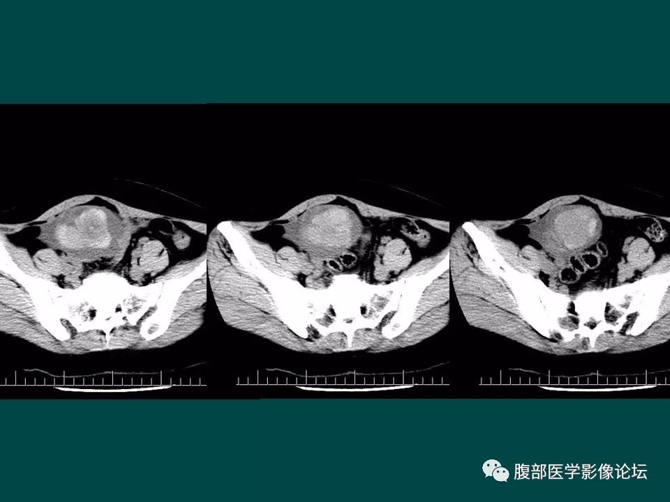 【病例】卵巢甲状腺肿1例CT
