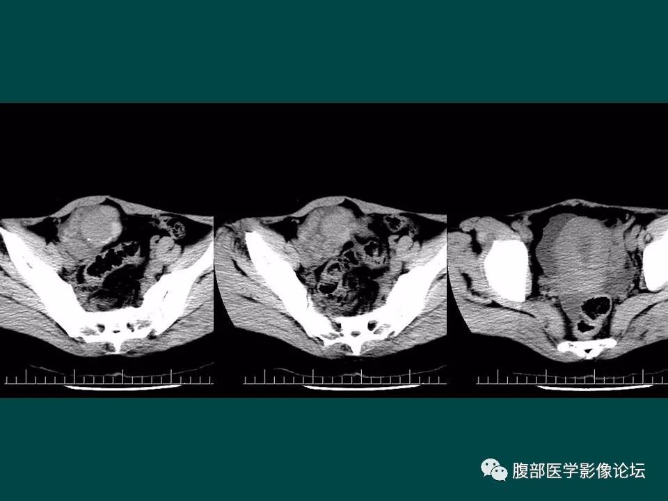 【病例】卵巢甲状腺肿1例CT