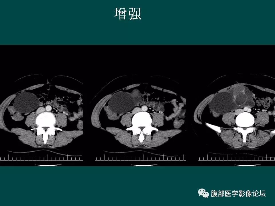 【病例】卵巢甲状腺肿1例CT