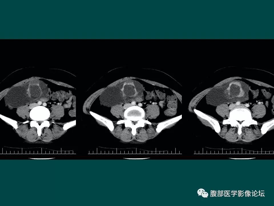 【病例】卵巢甲状腺肿1例CT
