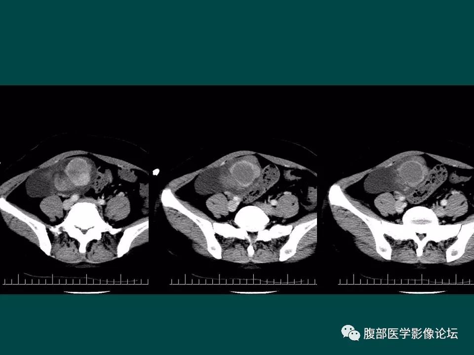 【病例】卵巢甲状腺肿1例CT