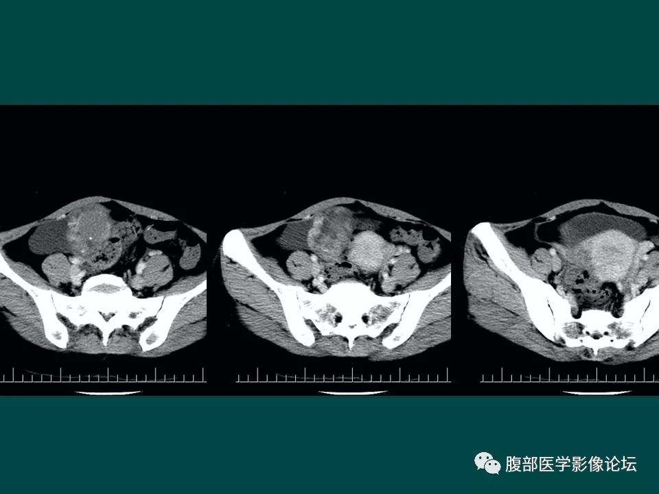 【病例】卵巢甲状腺肿1例CT