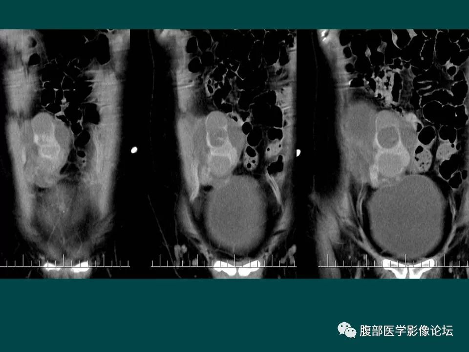 【病例】卵巢甲状腺肿1例CT