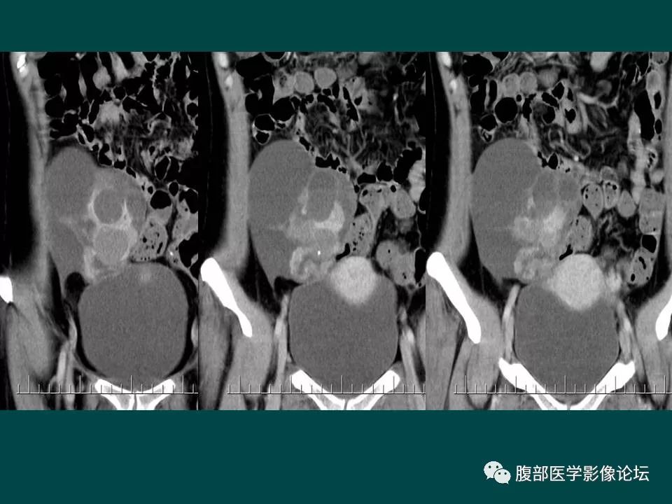 【病例】卵巢甲状腺肿1例CT