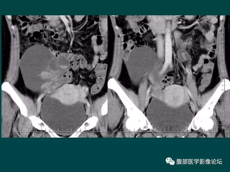 【病例】卵巢甲状腺肿1例CT