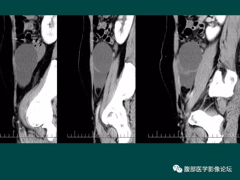 【病例】卵巢甲状腺肿1例CT