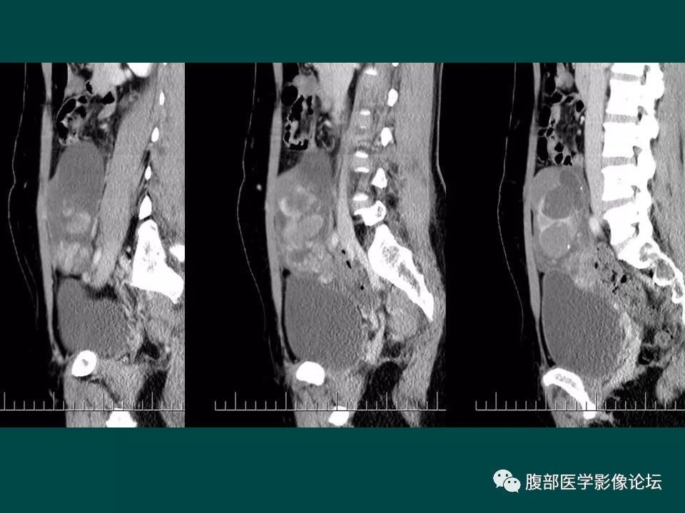 【病例】卵巢甲状腺肿1例CT