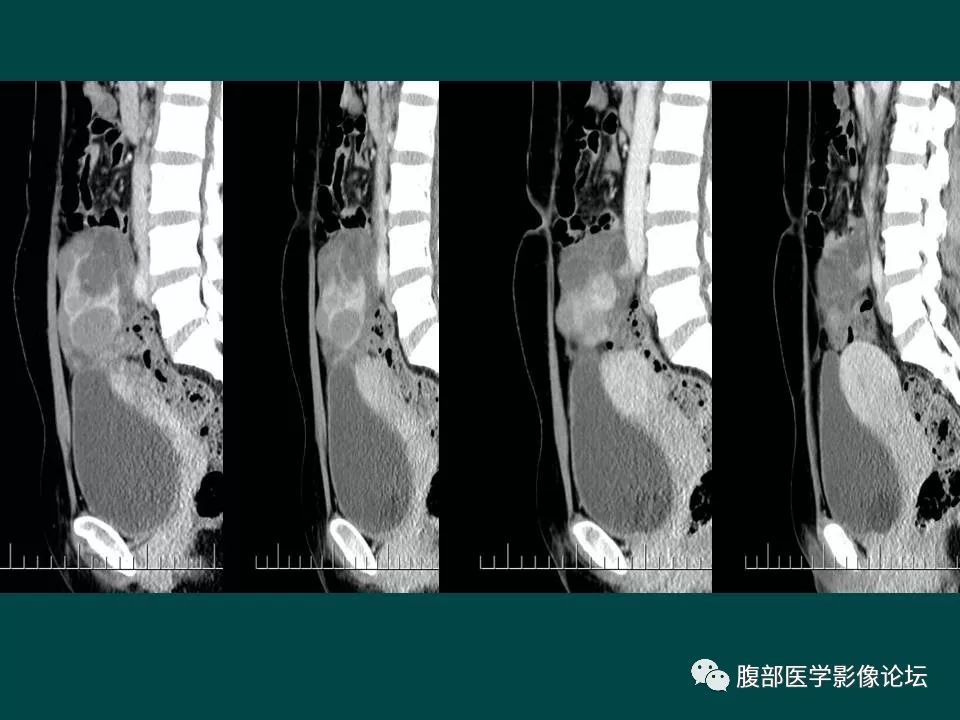 【病例】卵巢甲状腺肿1例CT