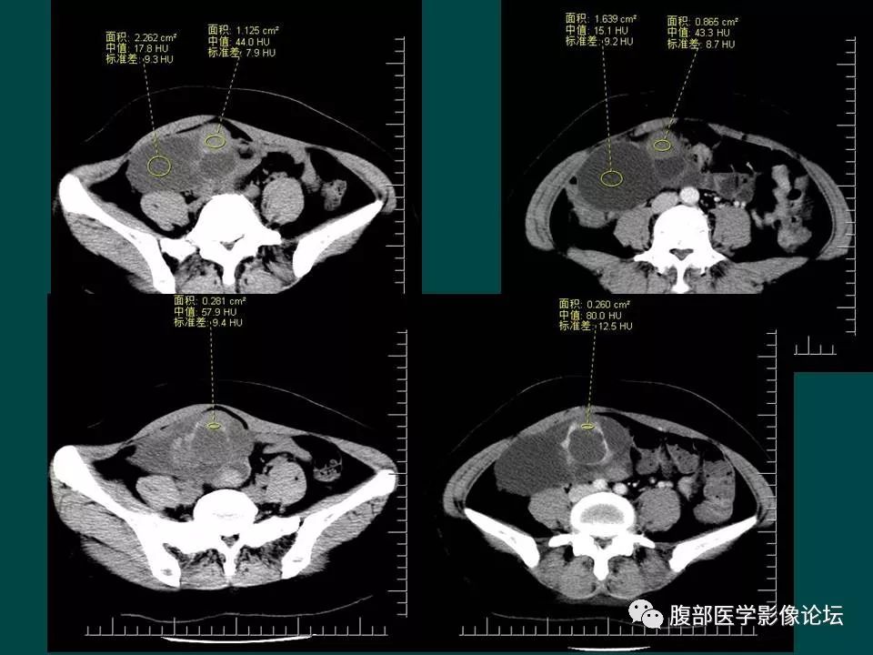 【病例】卵巢甲状腺肿1例CT