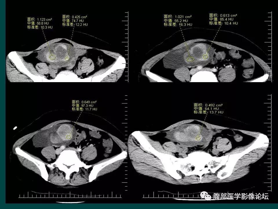【病例】卵巢甲状腺肿1例CT
