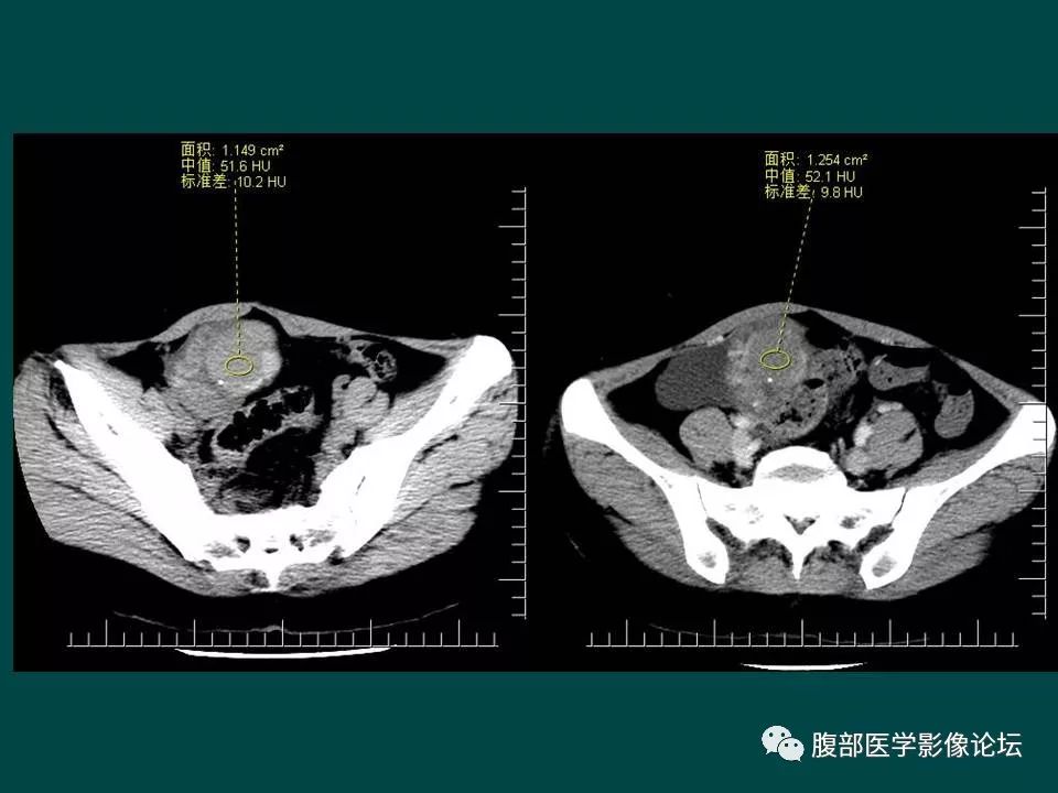【病例】卵巢甲状腺肿1例CT