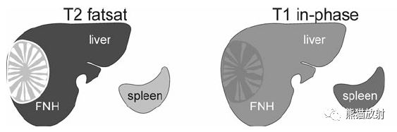 FNH：MRI表现与病理相关性