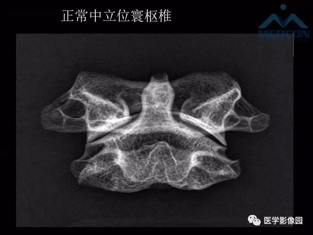 【PPT】寰枢关节脱位的影像诊断