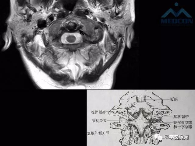 【PPT】寰枢关节脱位的影像诊断
