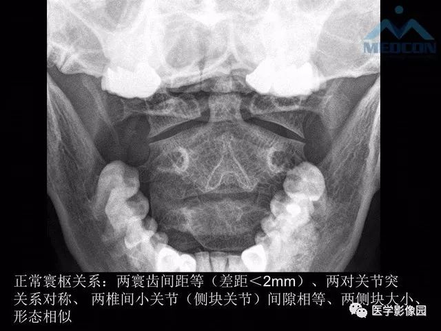 【PPT】寰枢关节脱位的影像诊断