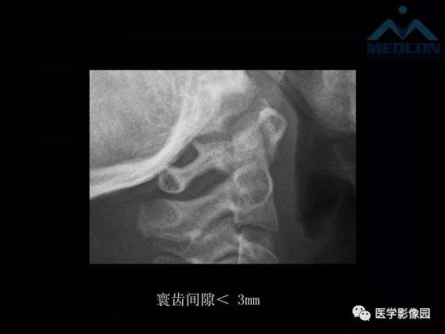 【PPT】寰枢关节脱位的影像诊断