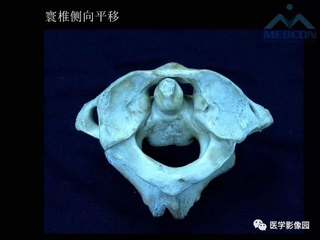 【PPT】寰枢关节脱位的影像诊断