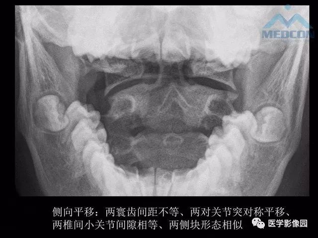 【PPT】寰枢关节脱位的影像诊断