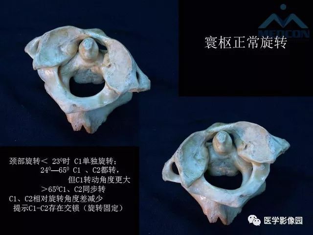 【PPT】寰枢关节脱位的影像诊断