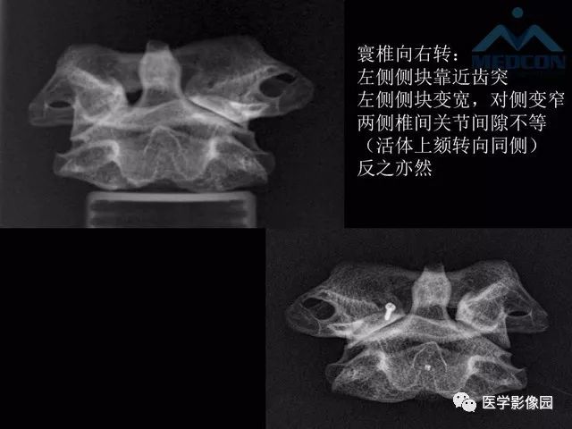 【PPT】寰枢关节脱位的影像诊断