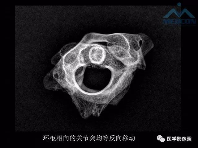 【PPT】寰枢关节脱位的影像诊断