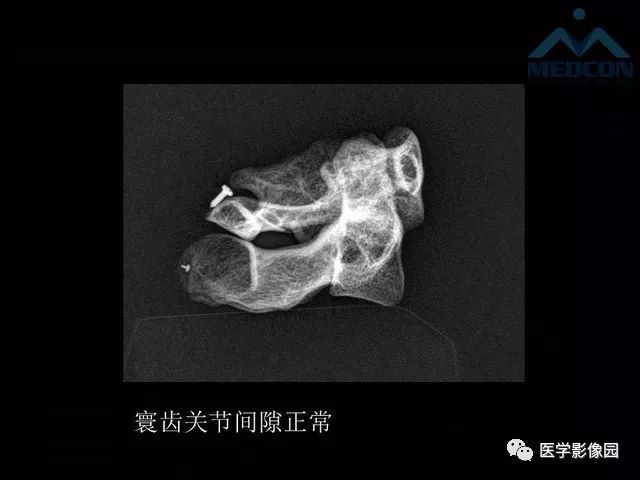 【PPT】寰枢关节脱位的影像诊断