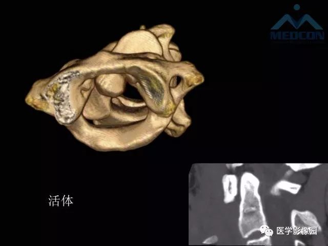 【PPT】寰枢关节脱位的影像诊断