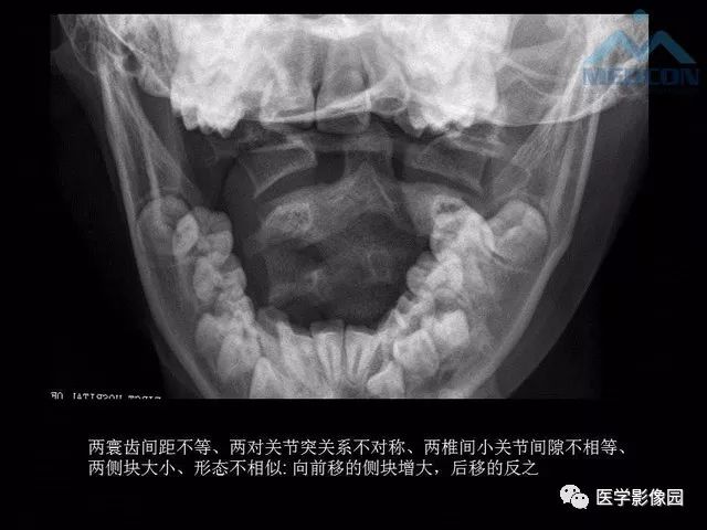【PPT】寰枢关节脱位的影像诊断