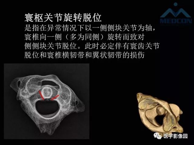 【PPT】寰枢关节脱位的影像诊断