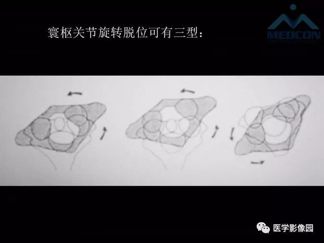 【PPT】寰枢关节脱位的影像诊断