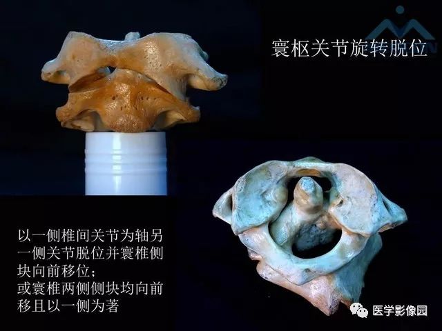 【PPT】寰枢关节脱位的影像诊断